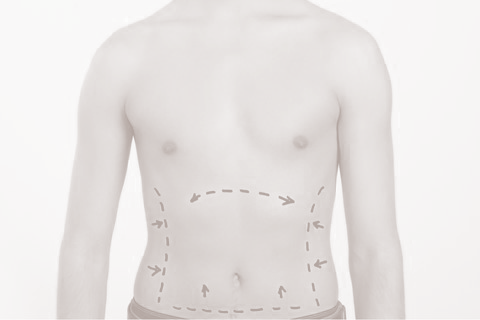 Liposuction